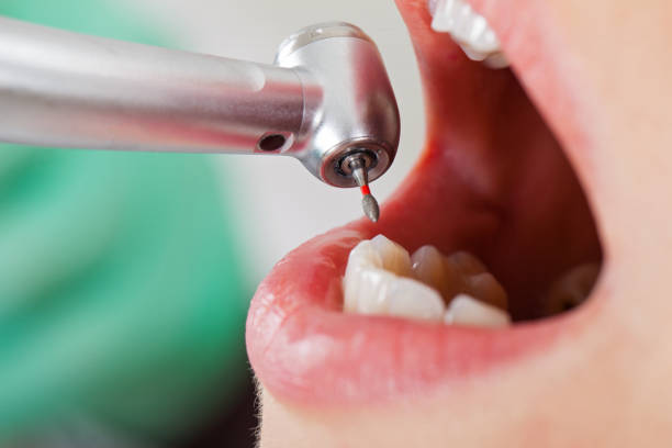 Best Broken or Cracked Tooth Emergency Dentist in Brandywine, MD